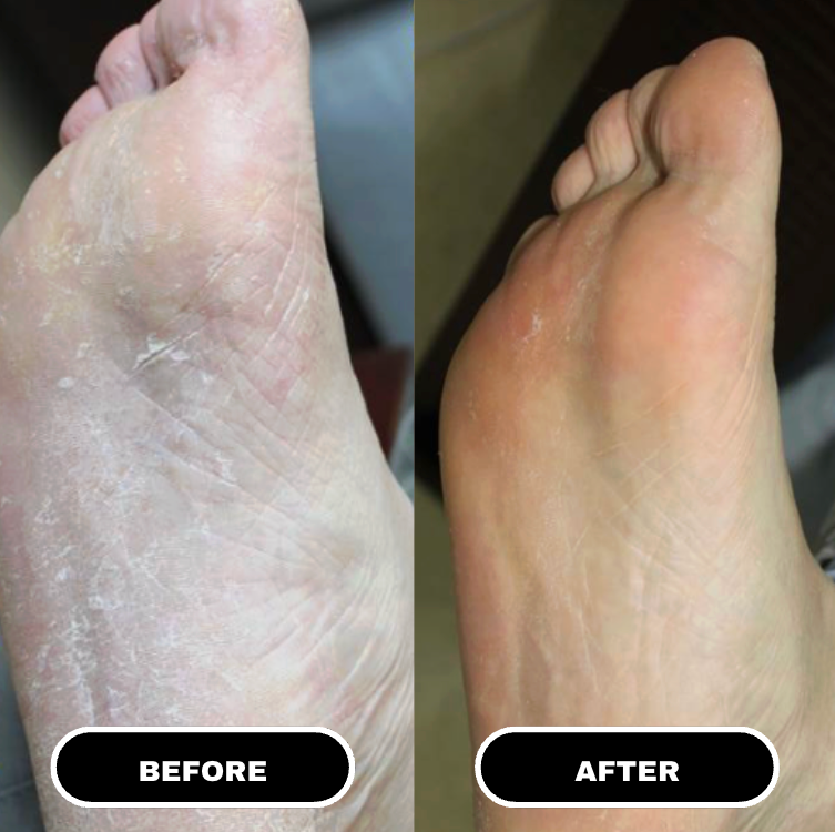 Antes e depois sola do pé